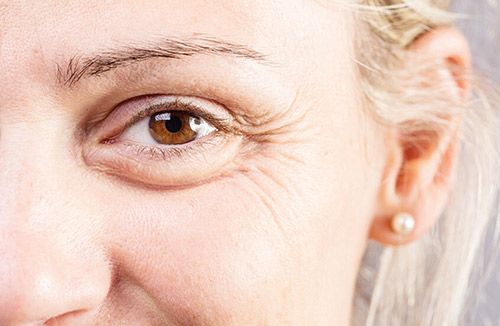 تجاعيد حول العين قد تنذر بتراجع صحة الدماغ